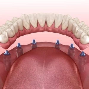 6 implanton nyugvó 4 szöveg mellett kicsi