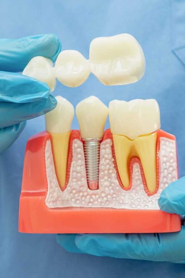 dental-implant-artificial-tooth-roots-into-jaw-r-2025-02-25-12-18-27-utc